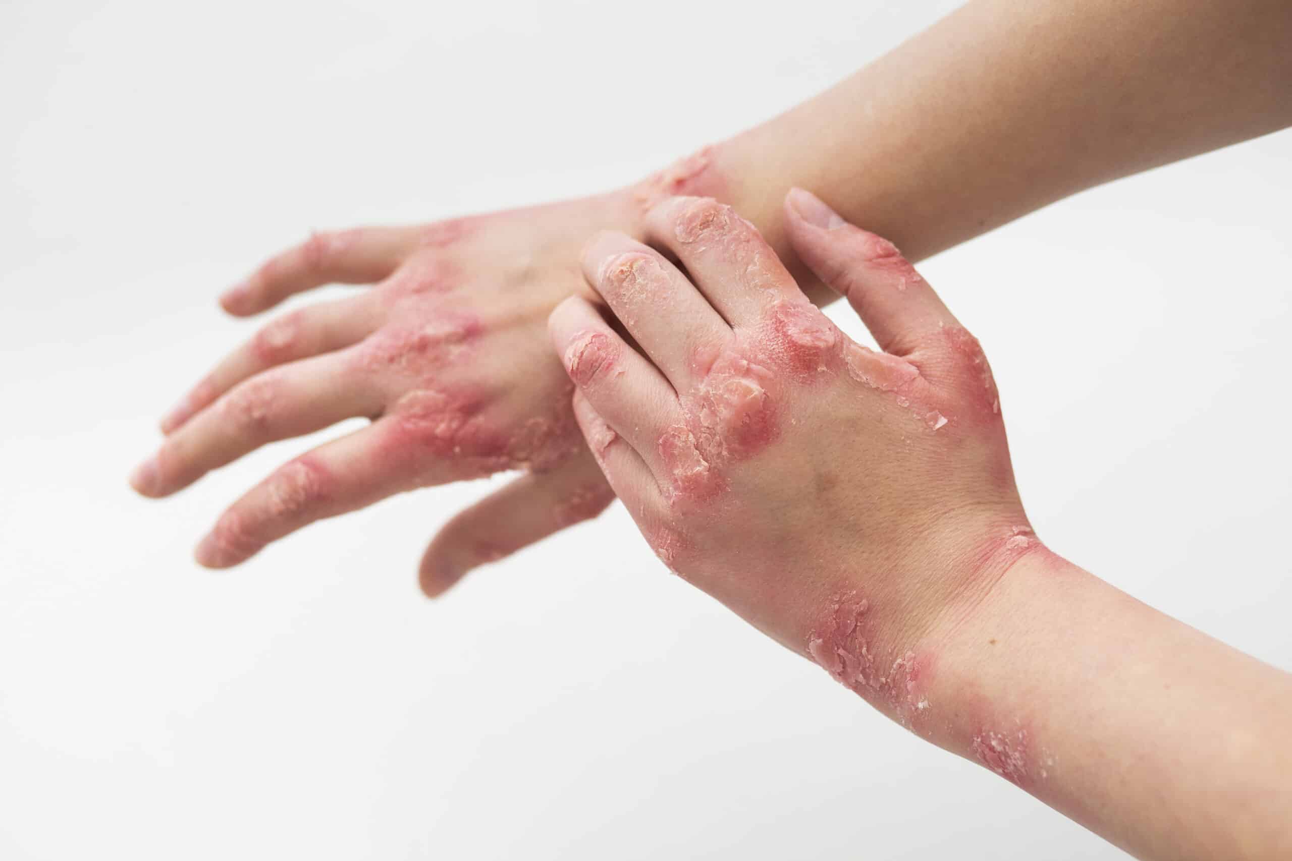 Comment reconnaît-on des boutons d'eczéma ? - Novabaume